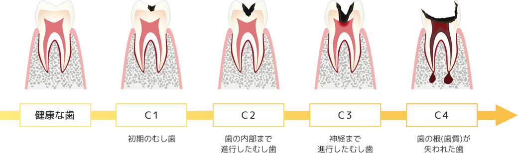 虫歯の進み方