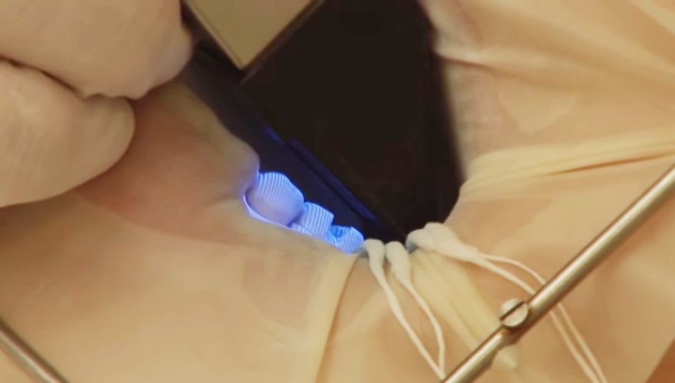 光学撮影で型取り